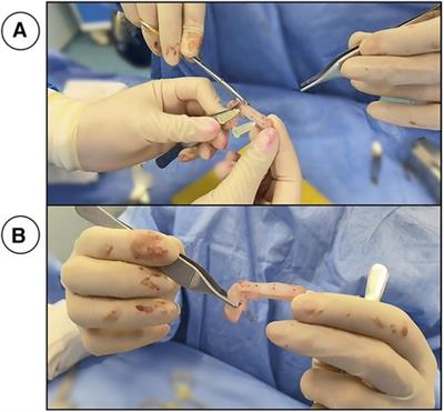 Sling-bridge technique: new technique in extracorporeal septorhinoplasty